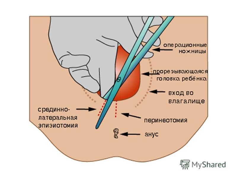 Перинеотомия и эпизиотомия презентация