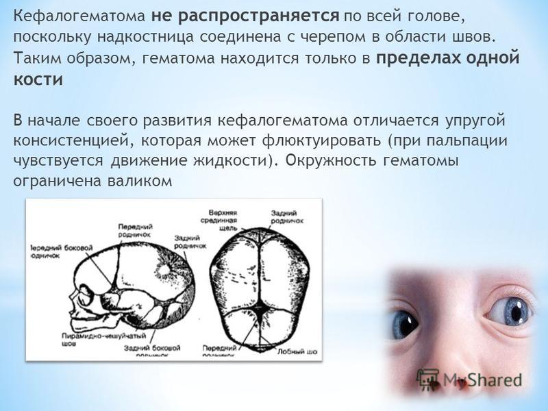 Температура родничок. Родовая травма кефалогематома. Кефалогематома на голове. Родовая гематома на голове у ребенка. Кеыеро гематома у ребенка на голове.