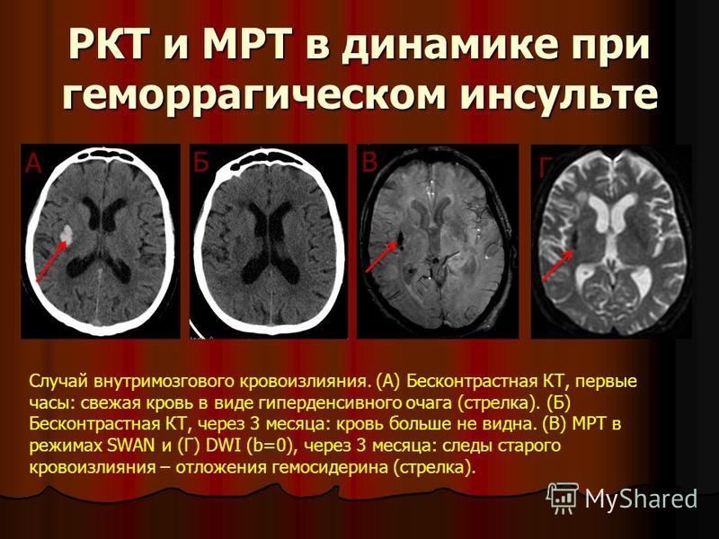 Ишемический инсульт головного мозга на мрт фото