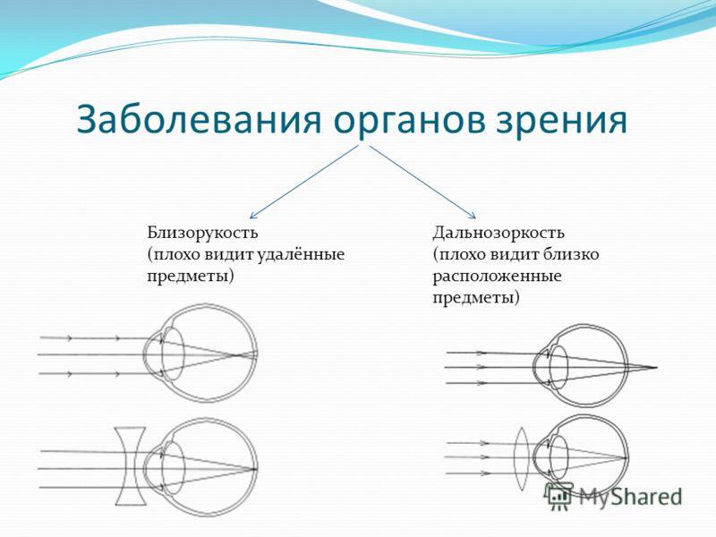 Дополните предложения изображение в близоруком