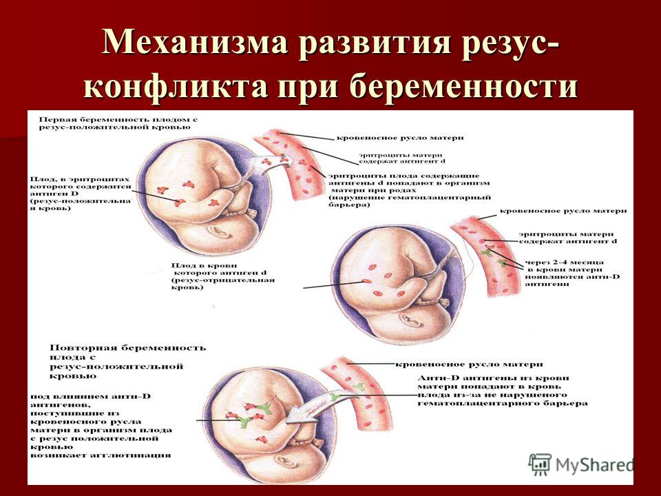 Резус конфликт при беременности. Механизм резус конфликта. Механизм возникновения резус конфликта. Механизм резус конфликта при беременности.