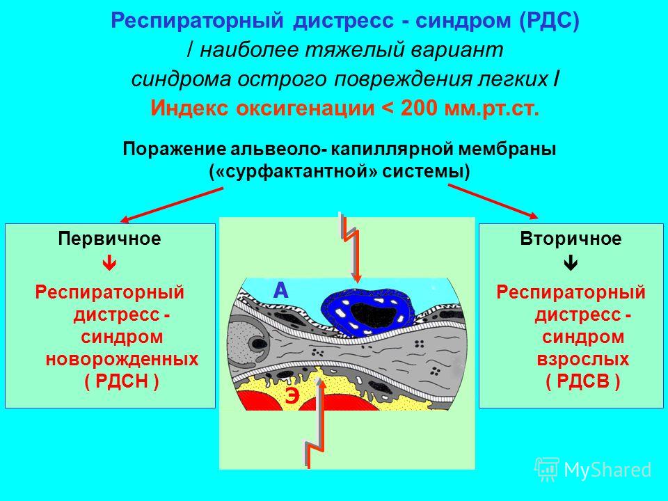 Респираторный дистресс синдром новорожденных презентация