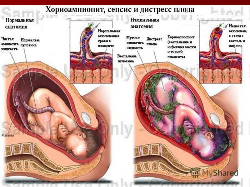 Хориоамнионит