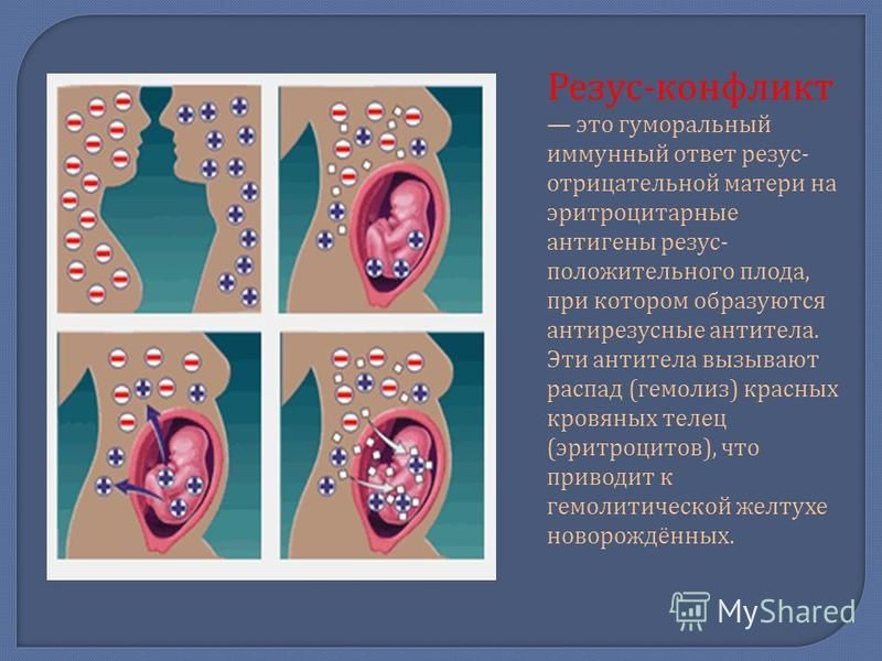 Резус несовместимость матери и плода