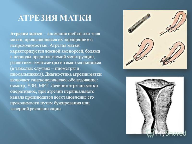 Матка каналы. Аномалии развития матки. Атрезия цервикального.