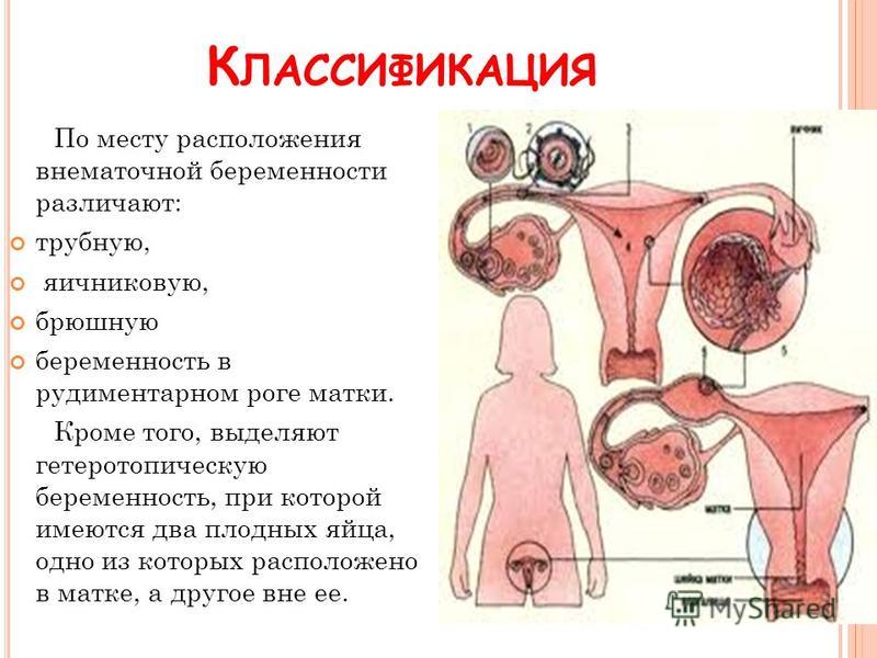 Брюшная беременность. Беременность в рудиментом Роге. При беременности в рудиментарном Роге. Внематочная беременность в рудиментарном Роге. Внематочной беременности в Роге матки.