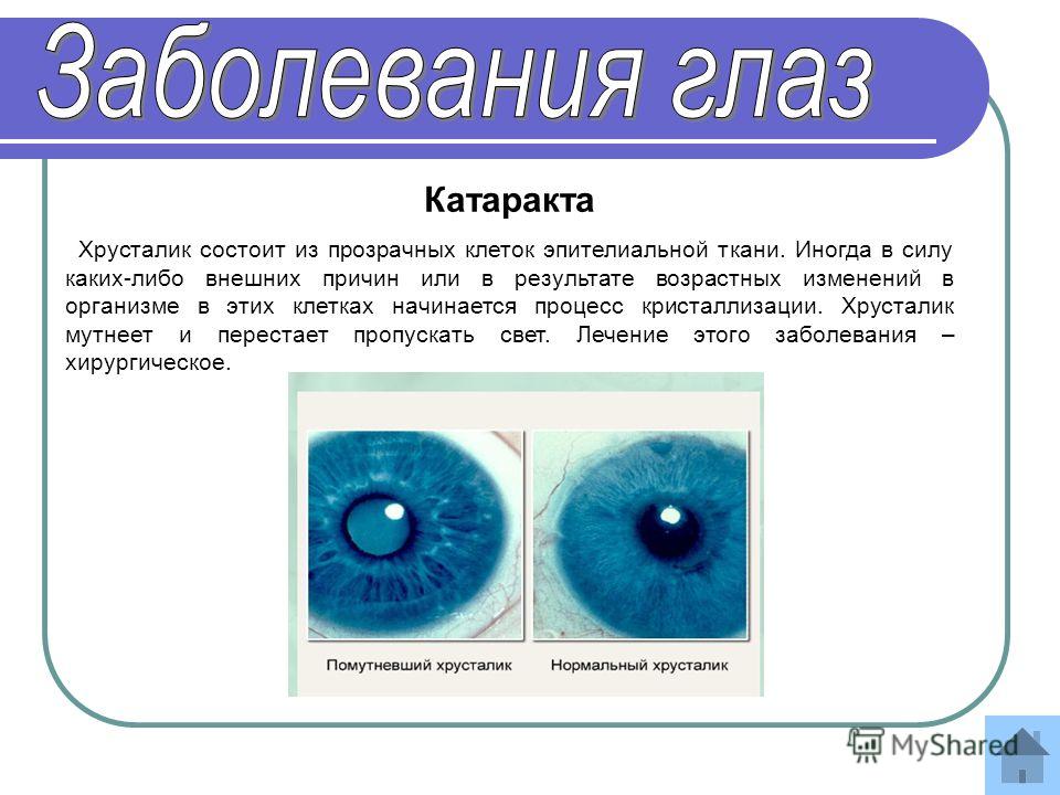 Заболевания органов зрения презентация