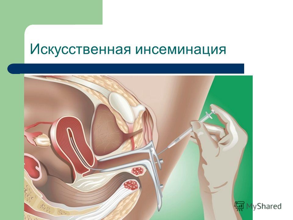 После иску. Искусственная инсеминация. Искусственная инсеминаци. Искусственная инсеминация матки. Процедура внутриматочной инсеминации.