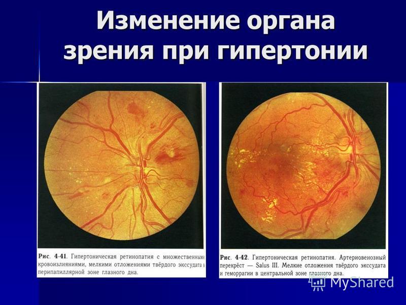 Гипертоническая ретинопатия стадии и клиническая картина