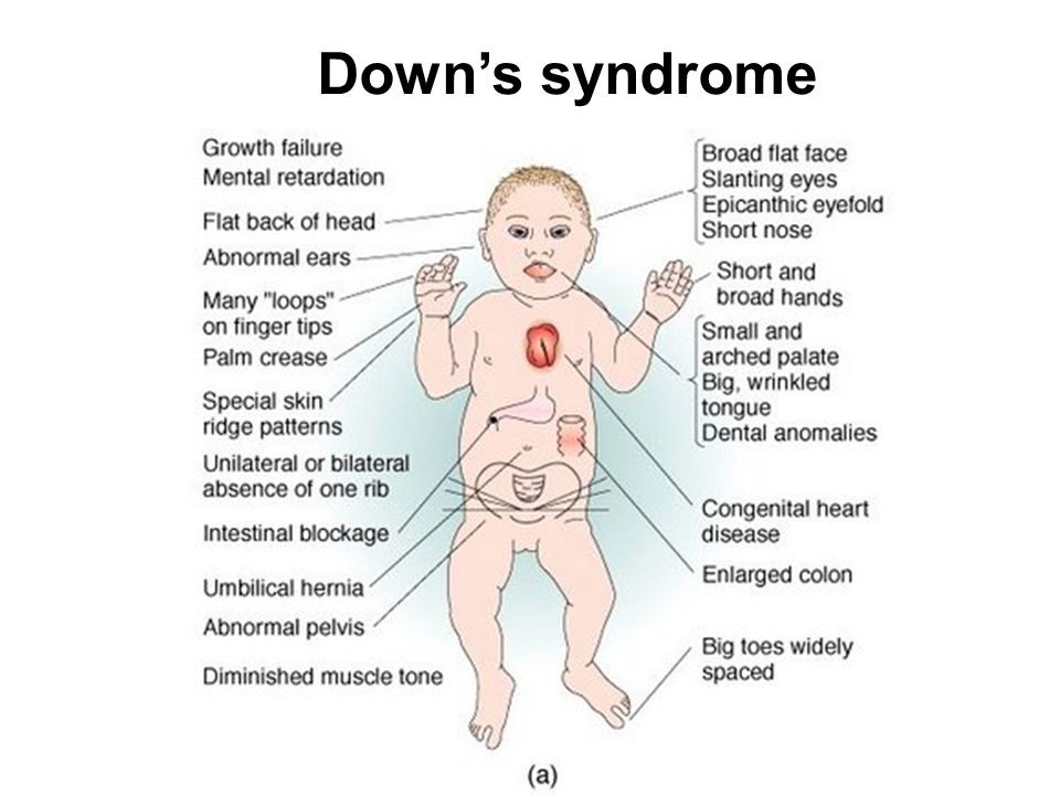 Синдром дауна картинки для презентации