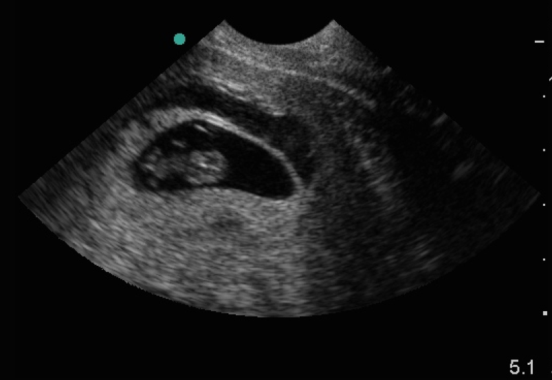 Отслойка 8 недель. Отслойка на 6 неделе беременности УЗИ. УЗИ 7 недель беременности гематома. УЗИ беременность 6 недель с гематомой. Отслойка плаценты гематома.