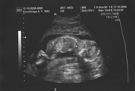 17 недель беременности фото узи