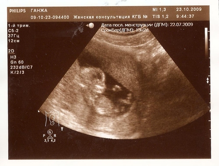 Плод 13 недель развития. УЗИ 13 акушерских недель. Размер эмбриона в 12-13 недель.