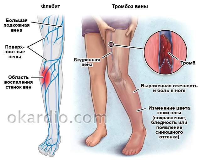 Ноет левая нога