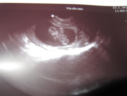 Конец 9 недели. УЗИ ребенка на 9 неделе беременности. УЗИ 9 недель беременности фото.