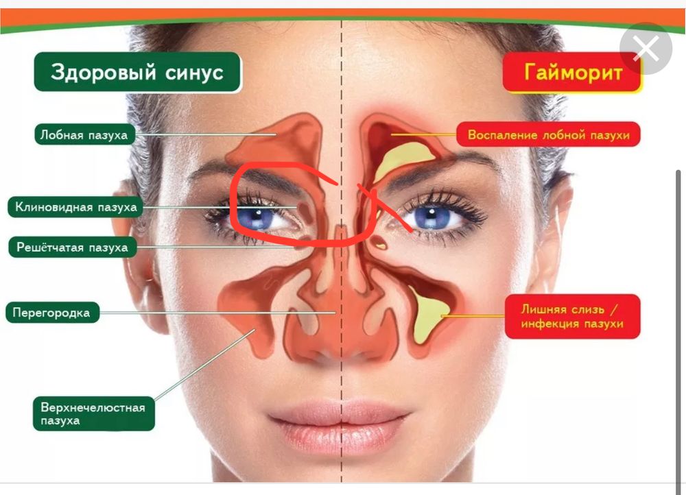 Схема лечения при гайморите
