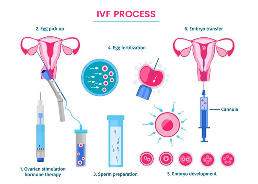 La inseminación in vitro