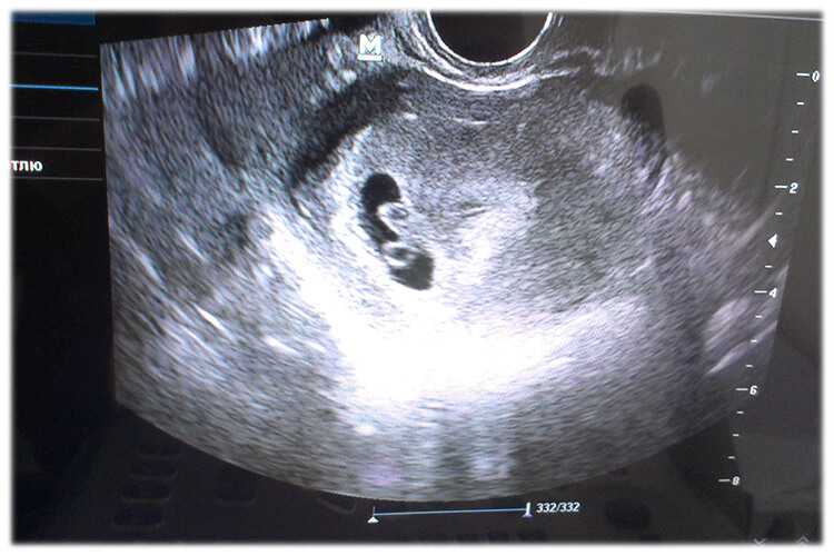 Шейка 6 недель. УЗИ на 7 акушерской неделе беременности. Эмбрион на 7 акушерской неделе беременности. Беременность 7 недель акушерских недель. Эмбрион на 7 неделе беременности УЗИ.