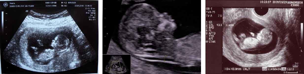 Малыш на 10 неделе беременности фото