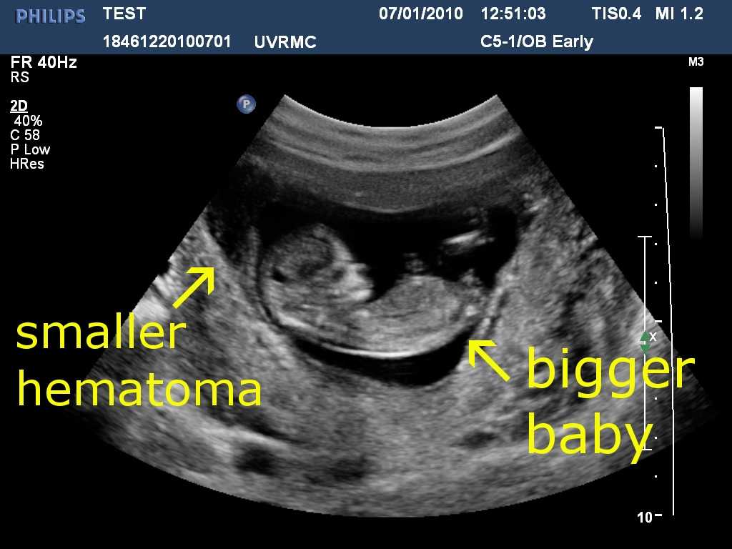 12 недель и 3 дня. Ретрохориальная гематома на 12 неделе беременности. Гематома в матке при беременности 12 недель.