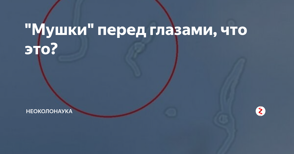 Мушки перед глазами причины у женщин