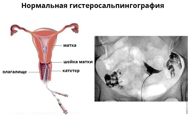 Трубы матки. Гистеросальпингография. Гистеросальпингография матки. Гистеросальпингография снимок.