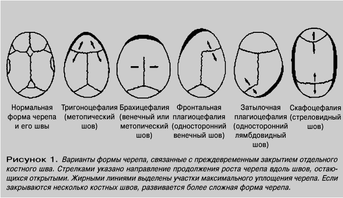 Варианты формы черепа. Форма черепа у детей норма и патология. Формы черепа у новорожденных нормы. Правильная форма черепа у младенца 3 месяца. Форма головы у грудничка при патологии.