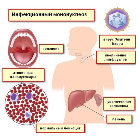 Вирус эпштейн барра заразен