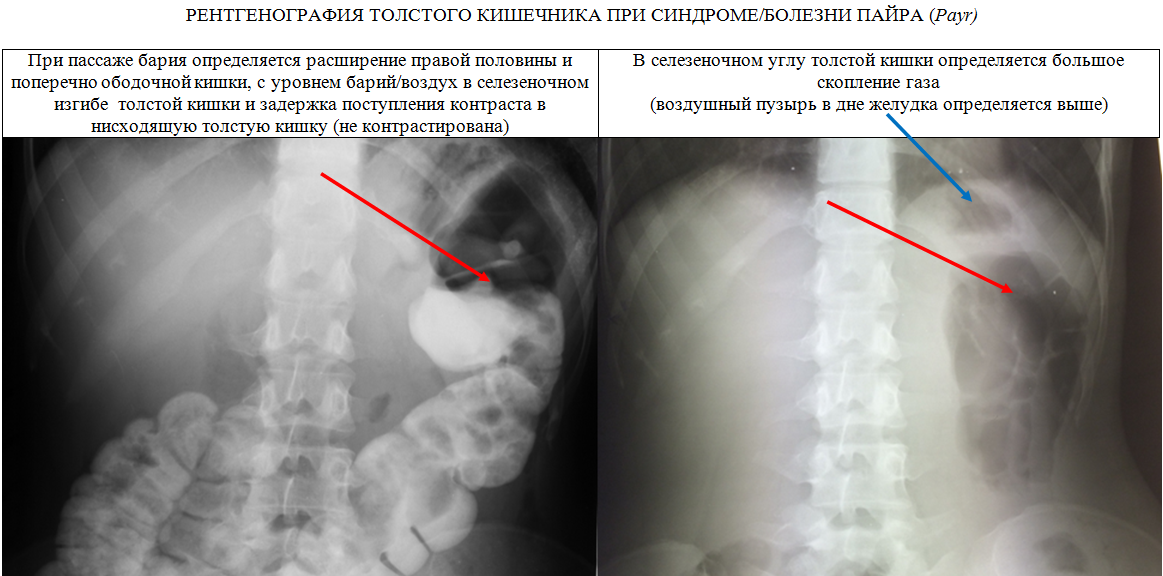 Селезеночный угол толстого. Синдром Пайра ирригография. Синдром Пайра ирригоскопия. Синдром Пайра на рентгенограмме.