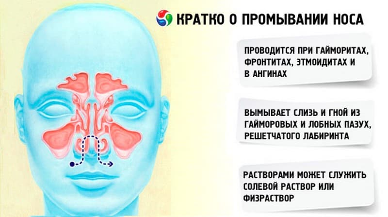 Промывание носа при гайморите. Носовые пазухи строение гайморит. Как промывать нос. Схема промывания носа.