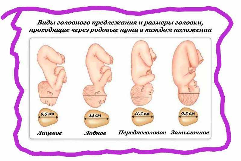 Продольное предлежание плода при беременности фото