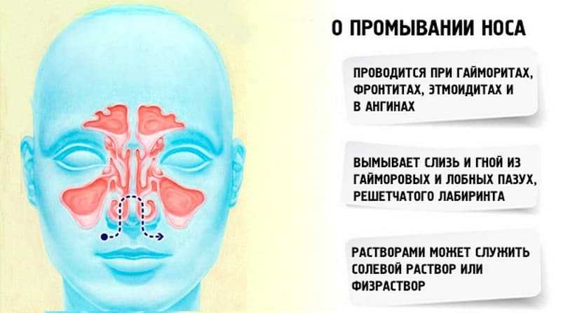 Как промыть синусит