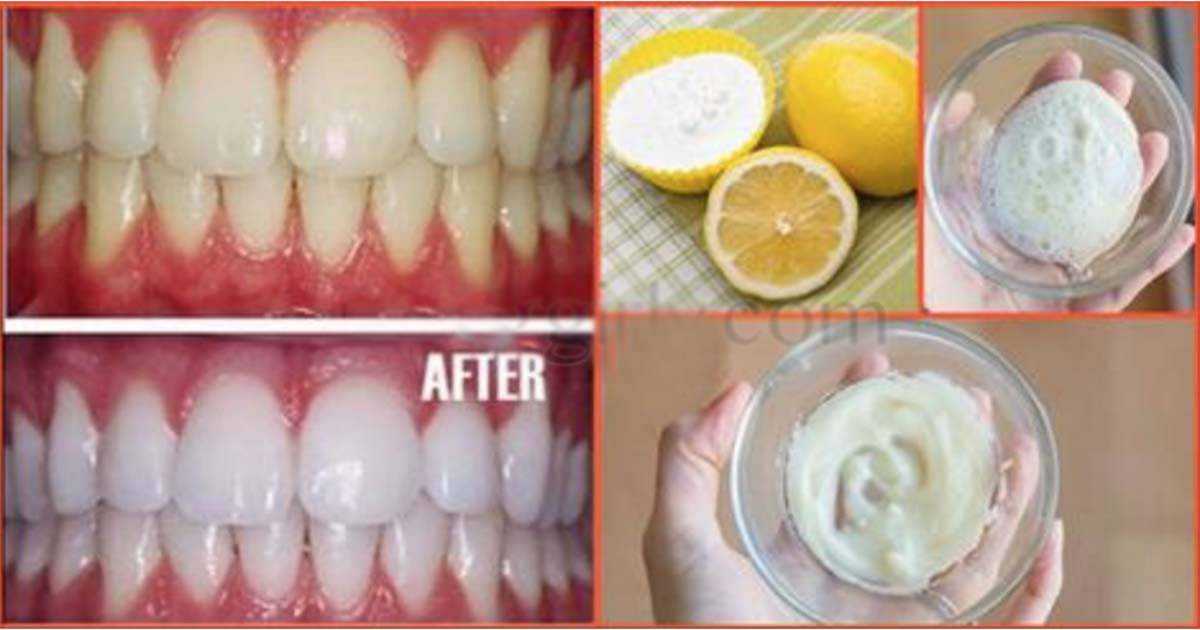 Пить после отбеливания зубов. Отбеливание зубов содой. Естественный отбел зубов. Рекомендации после отбеливания зубов.
