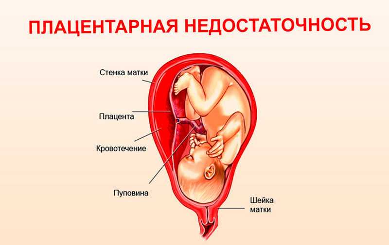 36 недель беременности кровь. Плацентарная недостаточность при беременности 3 триместр. Плацента с признаками плацентарной недостаточности. Вторичная плацентарная недостаточность. Многообразная акушерская патология недостаточность плаценты.