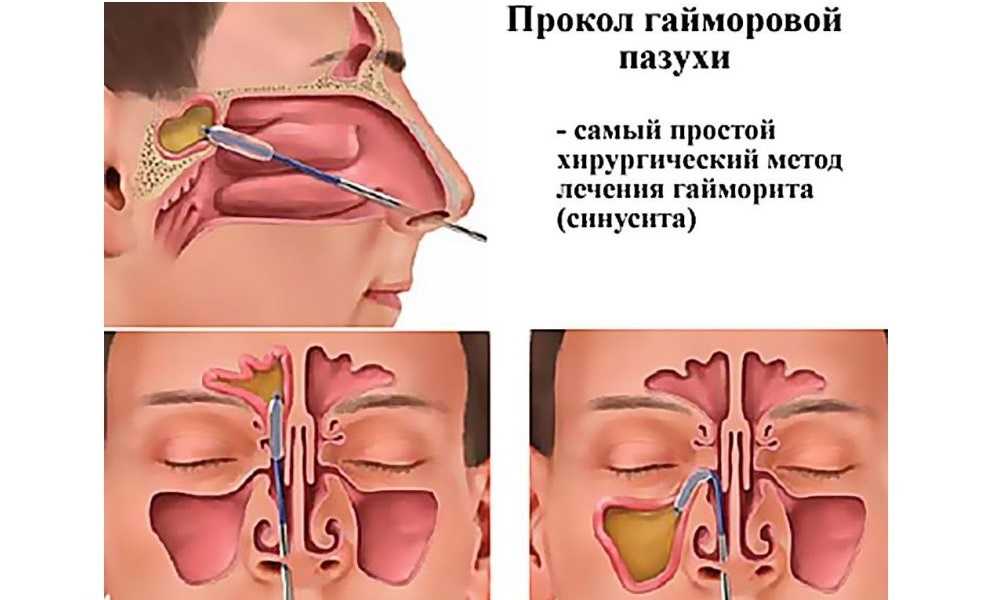 Пазухи в носу схема