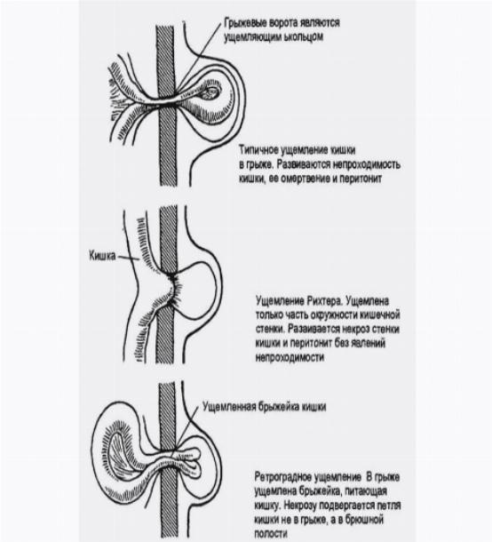 Пупочная грыжа рисунок схема