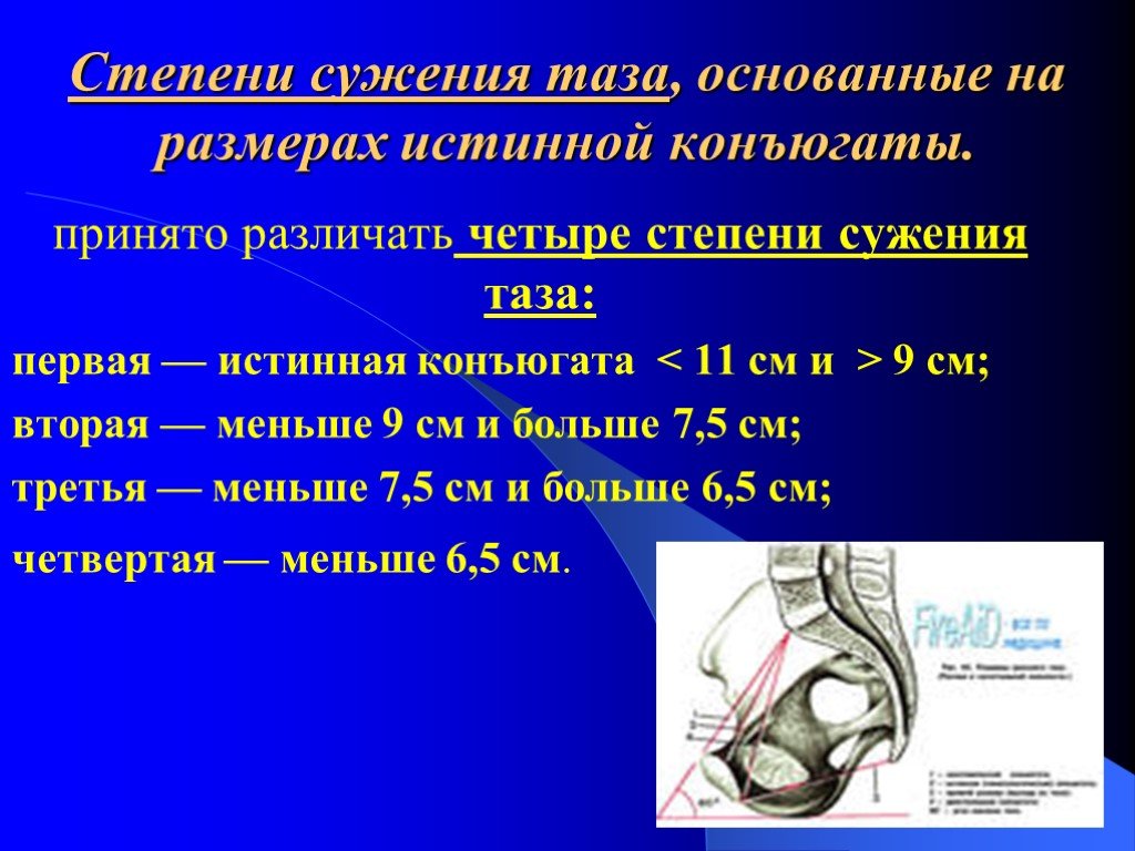 Конъюгат. Сужения таза в акушерстве. Нормы объемы таза Акушерство. Нормы таза в акушерстве. Размеры таза Акушерство Размеры.