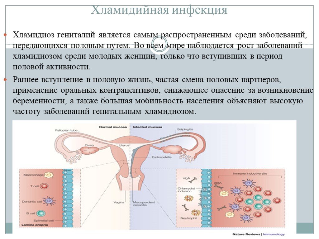 Хламидиоз у беременных презентация