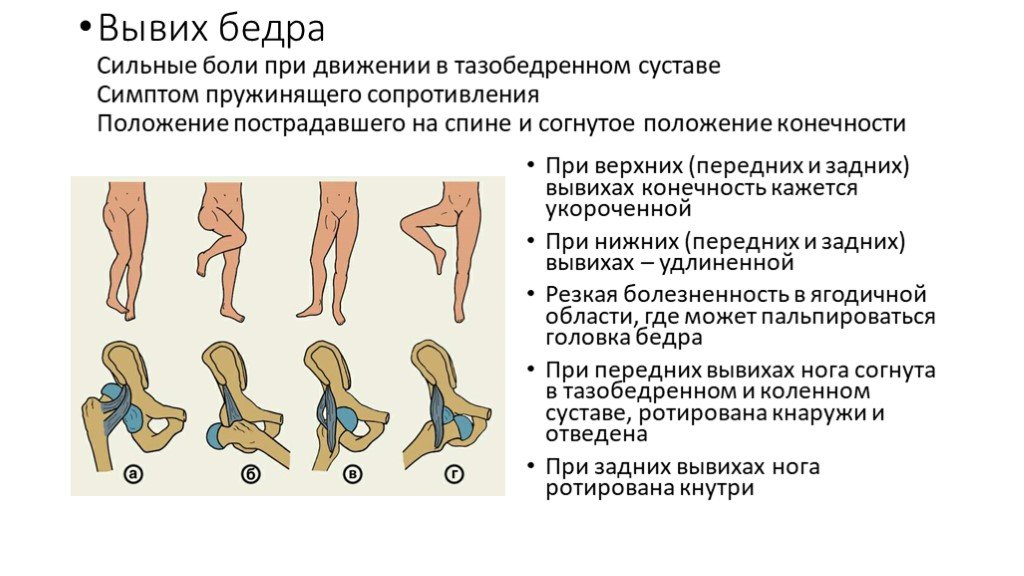 Растяжение связок бедра симптомы