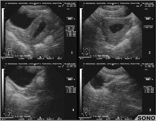 Матка увеличена до 6 недель. Синехии эндометрия на УЗИ. Полость матки расширена 2.2. Расширение полости матки на УЗИ. Расширенная полость матки на УЗИ.