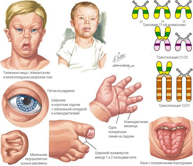 Клиническая картина синдрома дауна