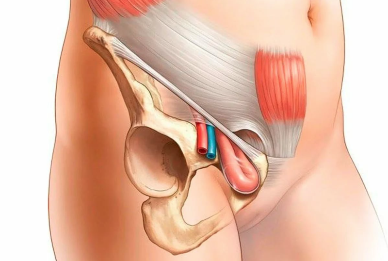 Боль в паху причины. Паховая и бедренная грыжа. Бедренная грыжа у мужчин.