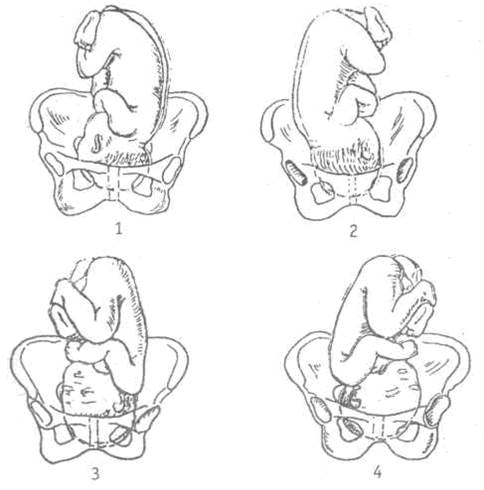 Тазовое предлежание первая позиция передний вид фото