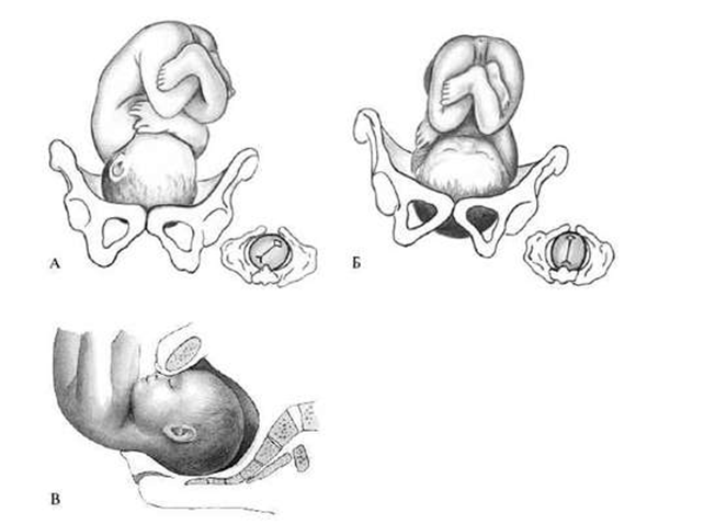 Роды в затылочном предлежании фото