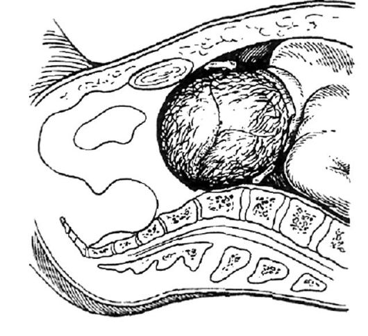 Четвертая беременность роды. Переднетеменной асинклитизм. Механизм родов при поперечносуженном тазе. Биомеханизм родов при поперечносуженном тазе.