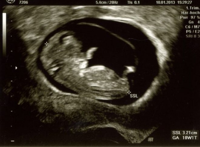 Симптомы 10 недели. 10 Недель беременности фото плода на УЗИ. Снимок УЗИ на 10 неделе беременности. УЗИ плода на 10 неделе беременности. УЗИ 9-10 недель беременности.
