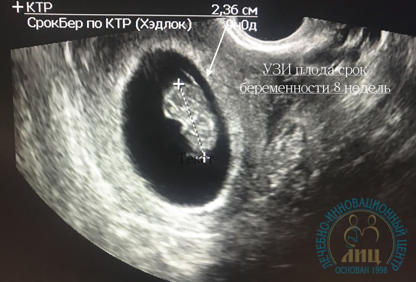 Россия 8 недель. УЗИ 7 недель беременности КТР плода. Как выглядит эмбрион в 8 недель на УЗИ. УЗИ на 8 неделе беременности акушерской. Зародыш 8 недель УЗИ.