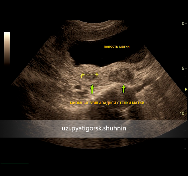 Ультразвуковая анатомия матки. Передняя и задняя стенка матки на УЗИ. Миома на задней стенке матки