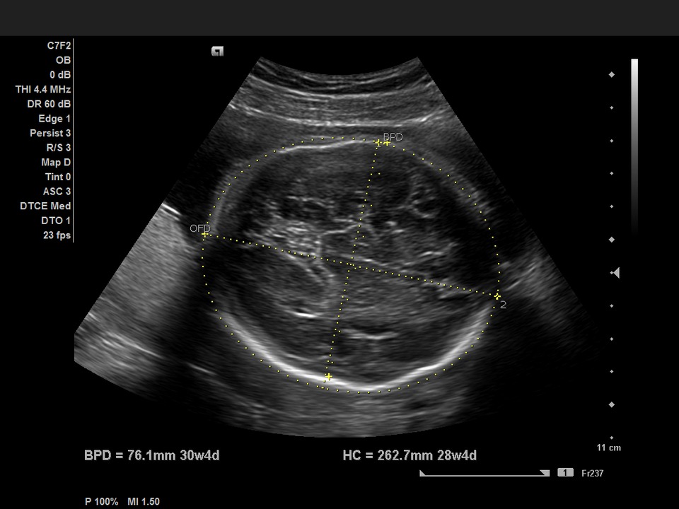 Бпр на узи при беременности. Измерение БПР на УЗИ. Бипариетальный размер головки плода по УЗИ. БПР УЗИ беременность. Ультразвуковое исследование при беременности-БПР.