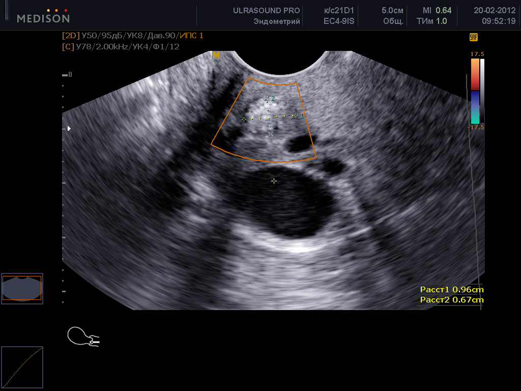 Как выглядит рак матки на узи фото